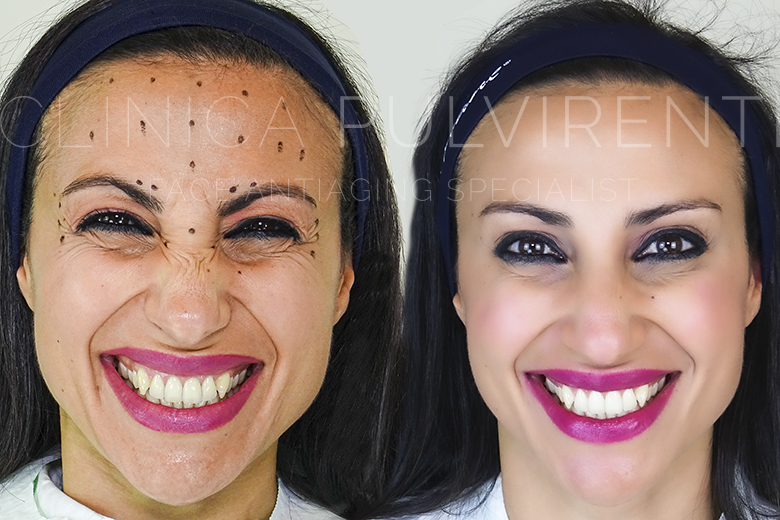 punturine_botox_catania_e_provincia Punturine Botox a Catania Offerte Botulino Medici Catania