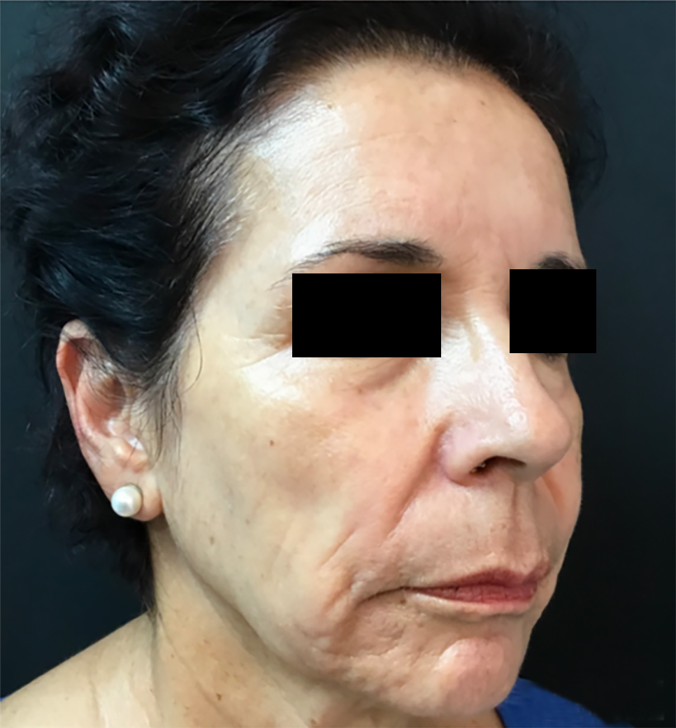 Filler rispristino volume viso PRIMA
