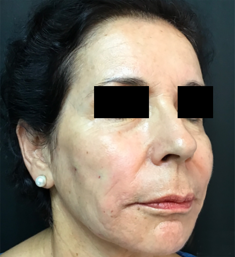 Filler rispristino volume viso DOPO