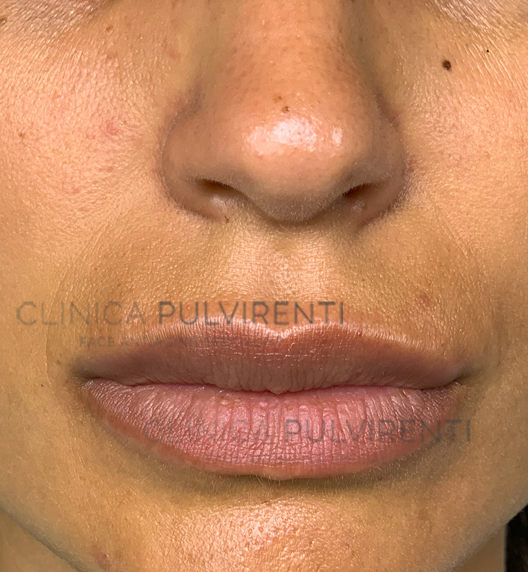 01_filler_labbra_dopo
