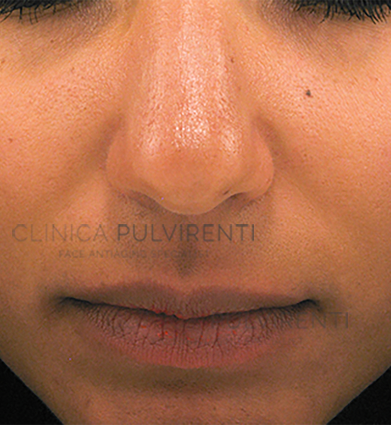 Filler Labbra Prima del trattamento