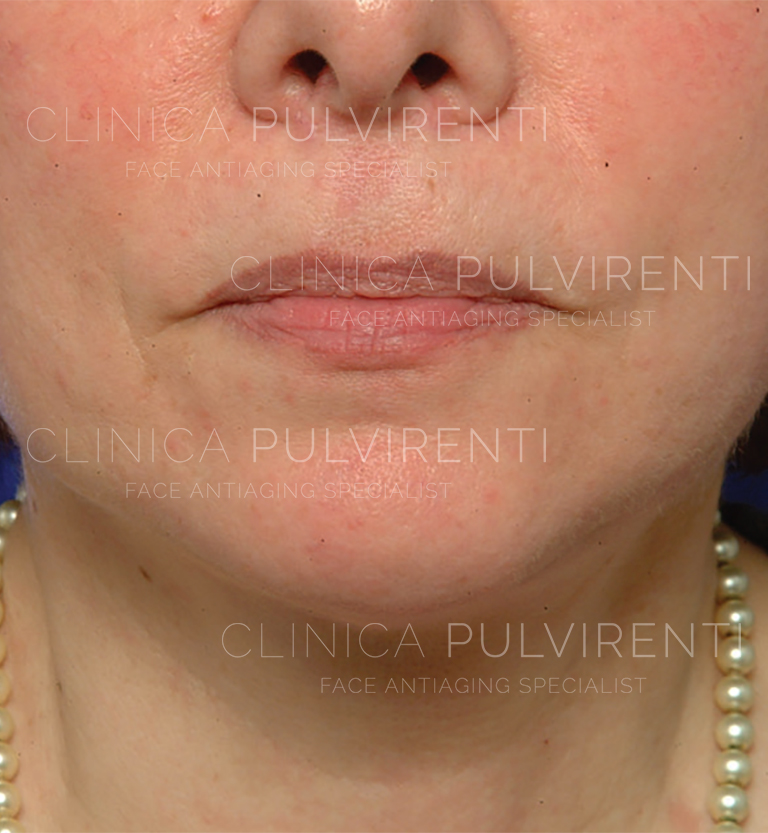 Dopo il trattamento di lipofilling con SEFFILLER a Catania, Sicilia