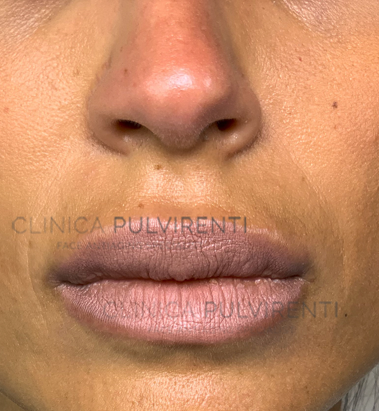 02_filler_labbra_dopo