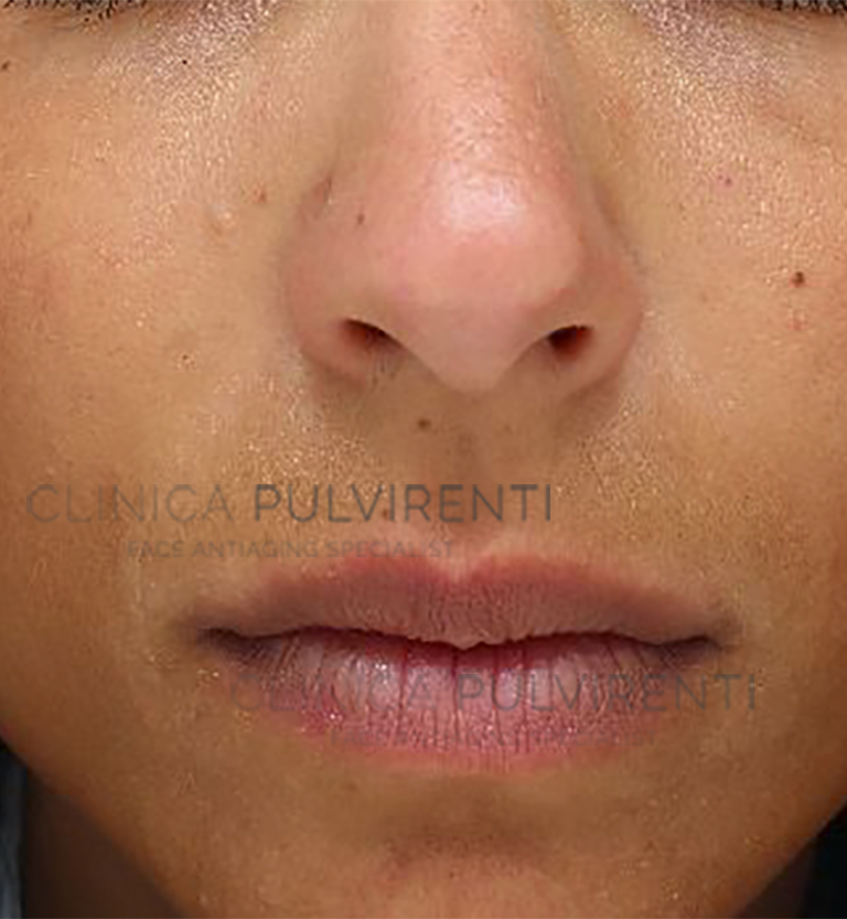 02_filler_labbra_prima