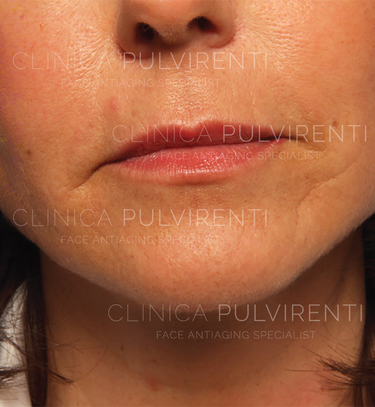 02_lipofiller_dopo