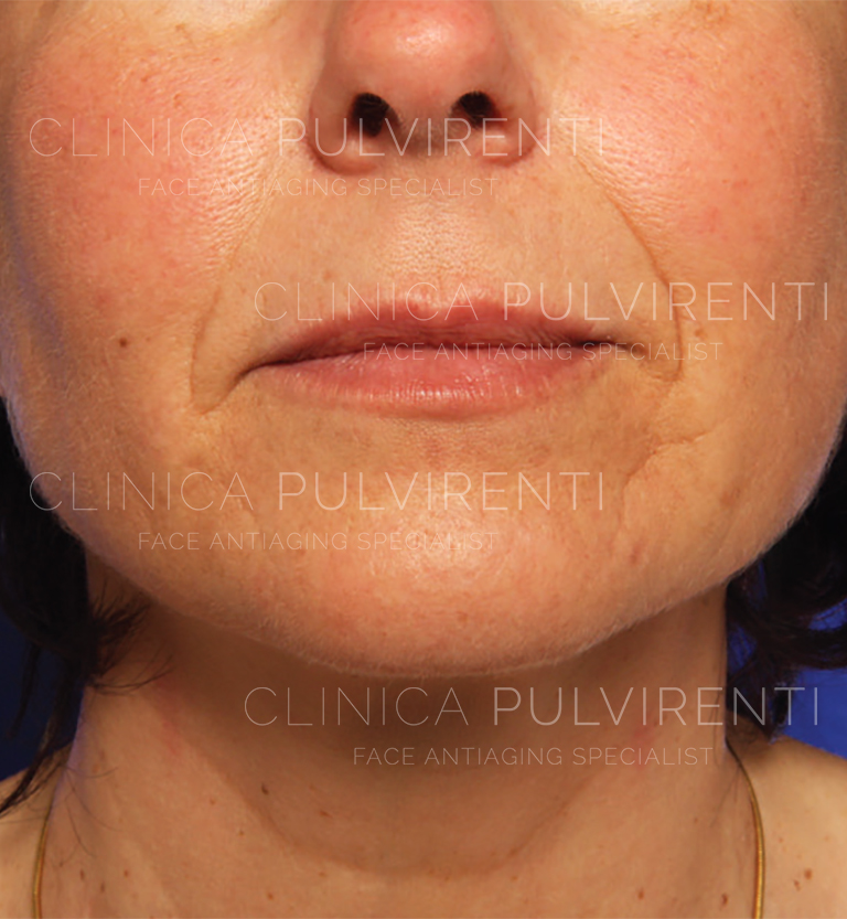 02_lipofiller_prima