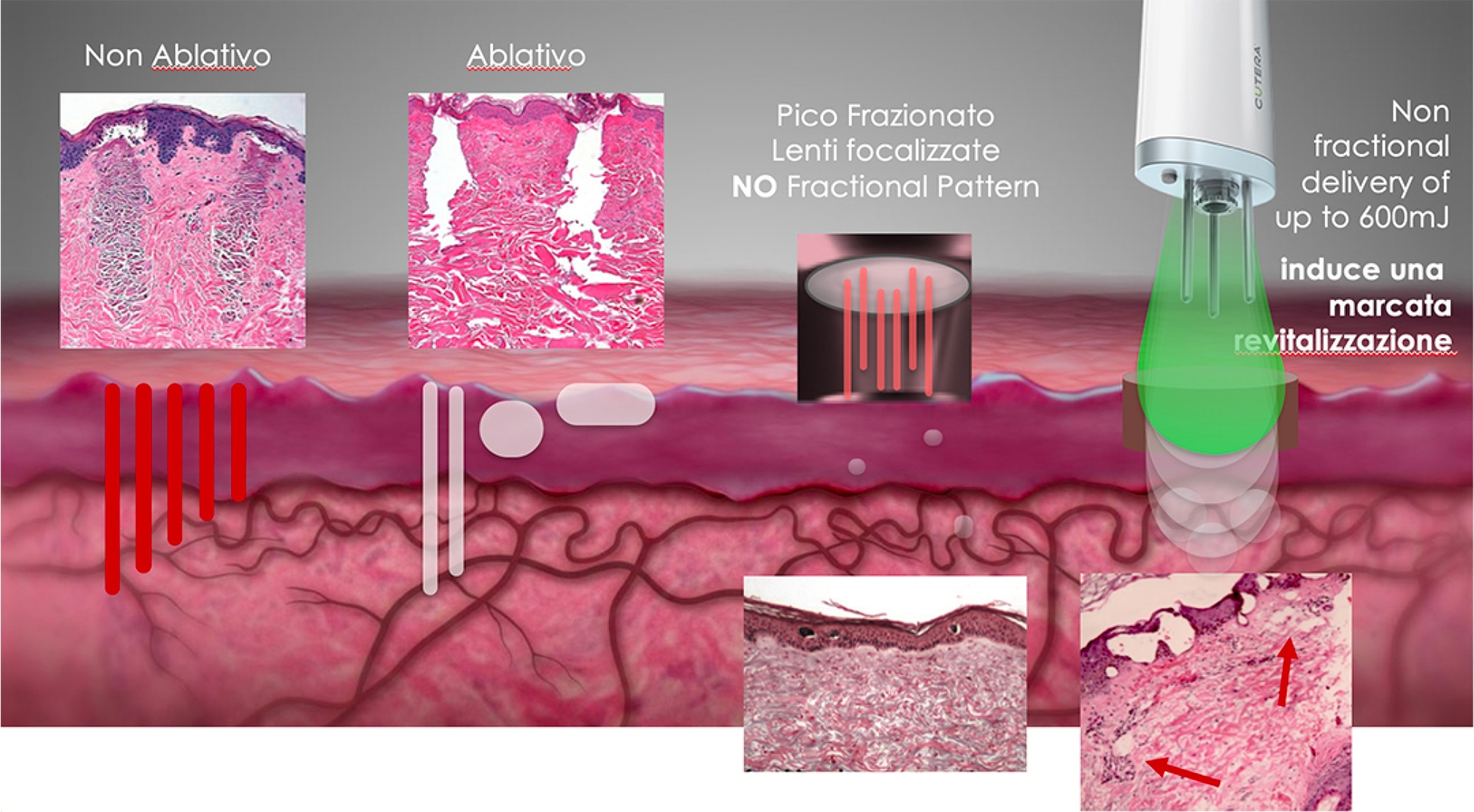 PICO_GENESIS_FX_Catania_rughe_viso Laser PICO Genesis FX trattamenti Laser Viso a Catania