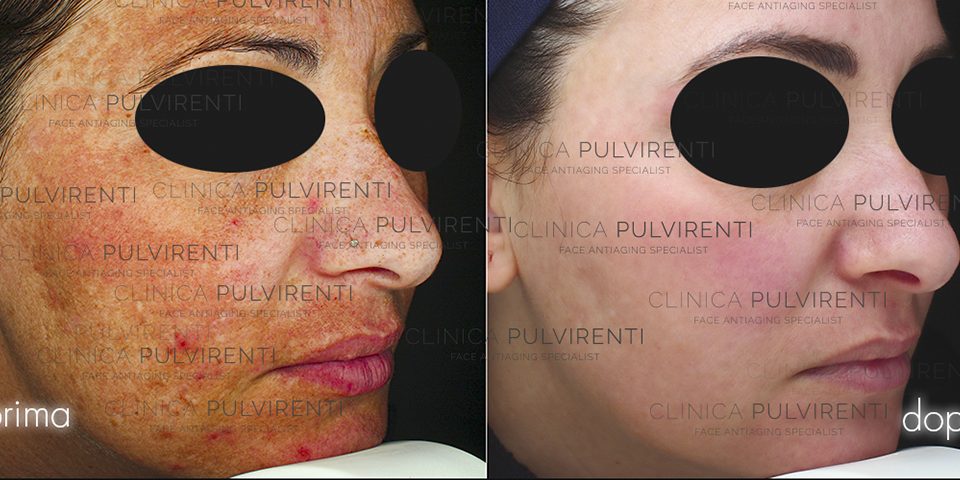 Rimozione delle macchie cutanee del Viso con Laser