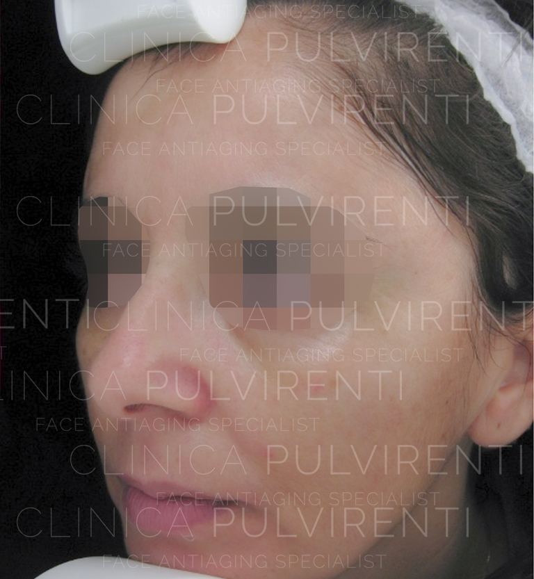 melasma dopo