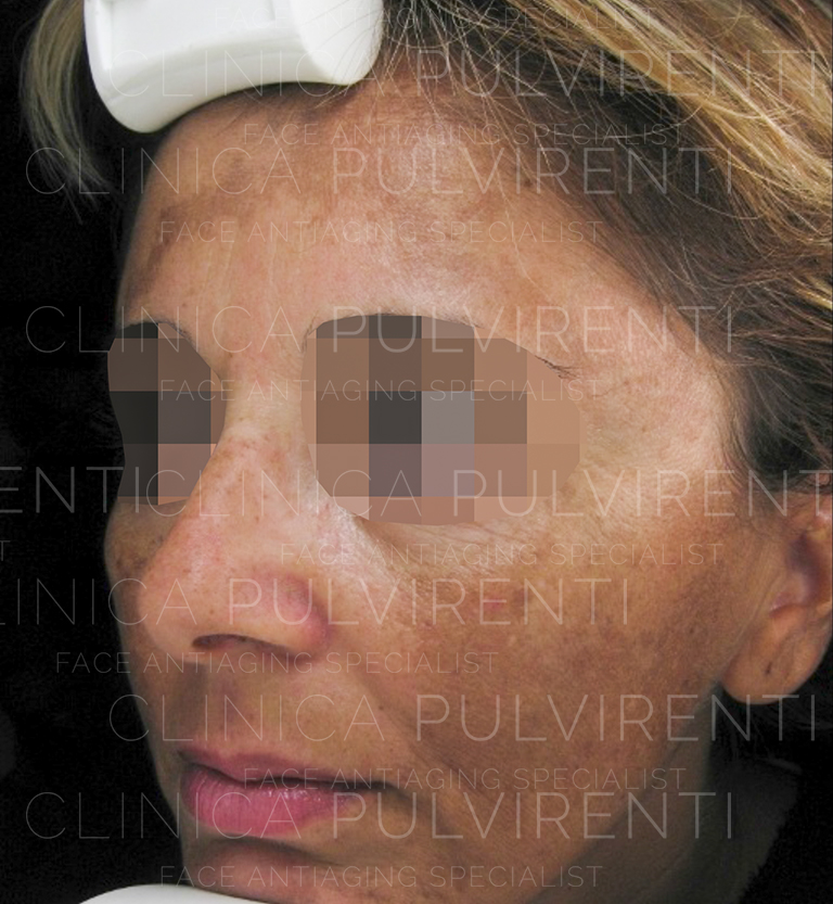 melasma prima