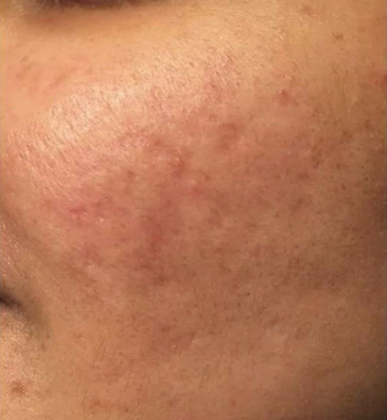 Laser co2 trattamento cicatrici acne dopo