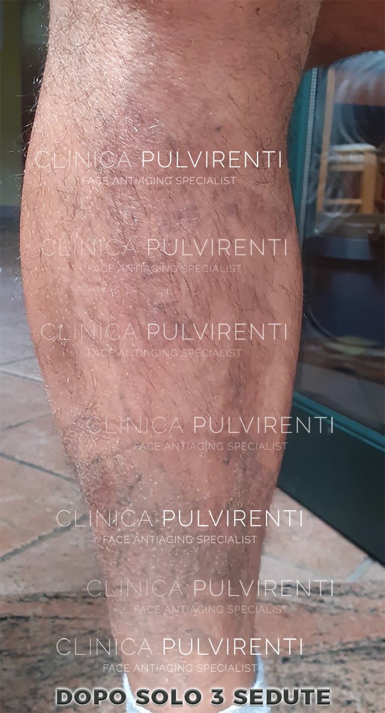 Esempio di rimozione tatuaggio con laser a picosecondi Catania