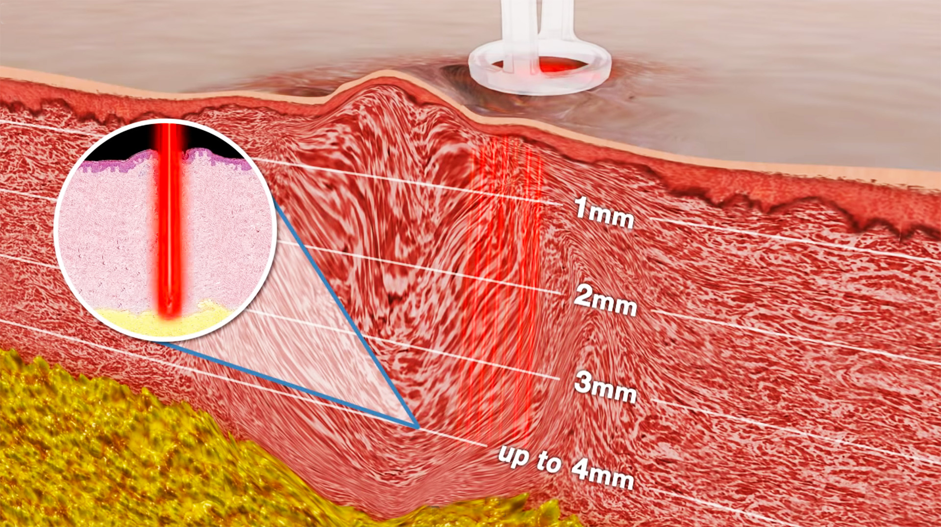 Trattamento Laser per acne a Giarre, Catania, Sicilia