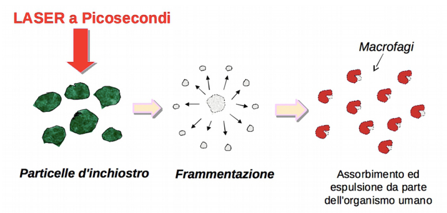 Azione dei macrofagi nel Laser a picosecondi