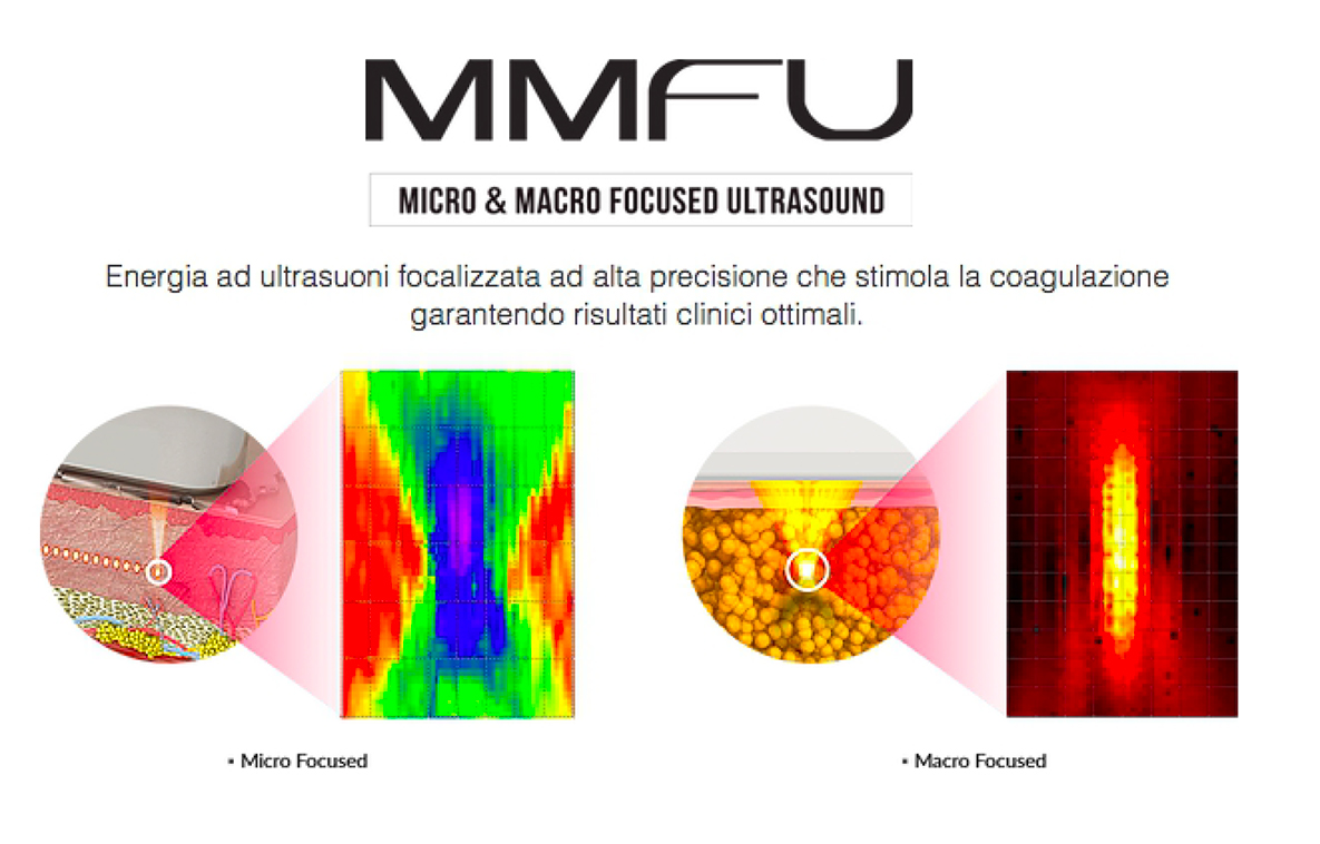 mmfu_ultrasuoni_microfocalizzati_a_catania