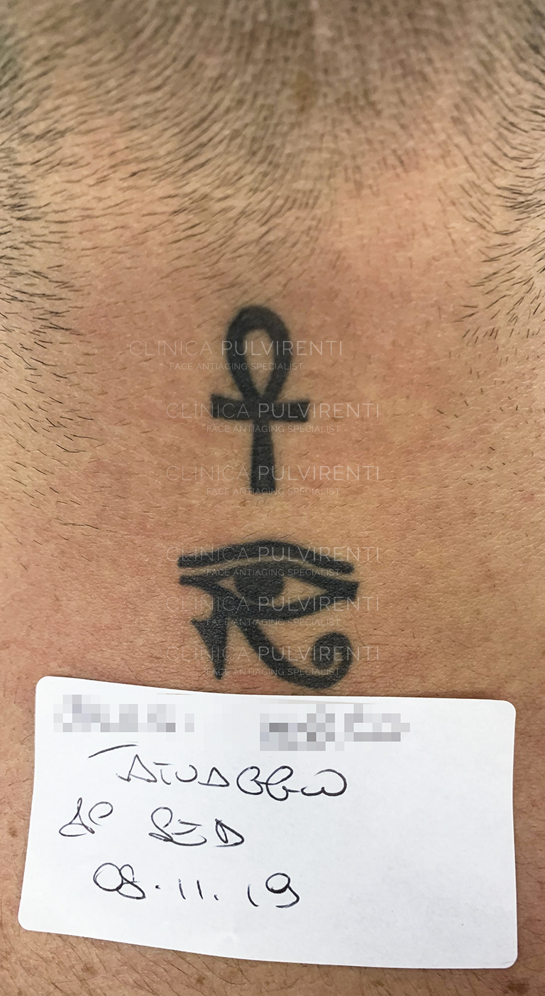 Eliminare tatuaggio con Laser a Palemo