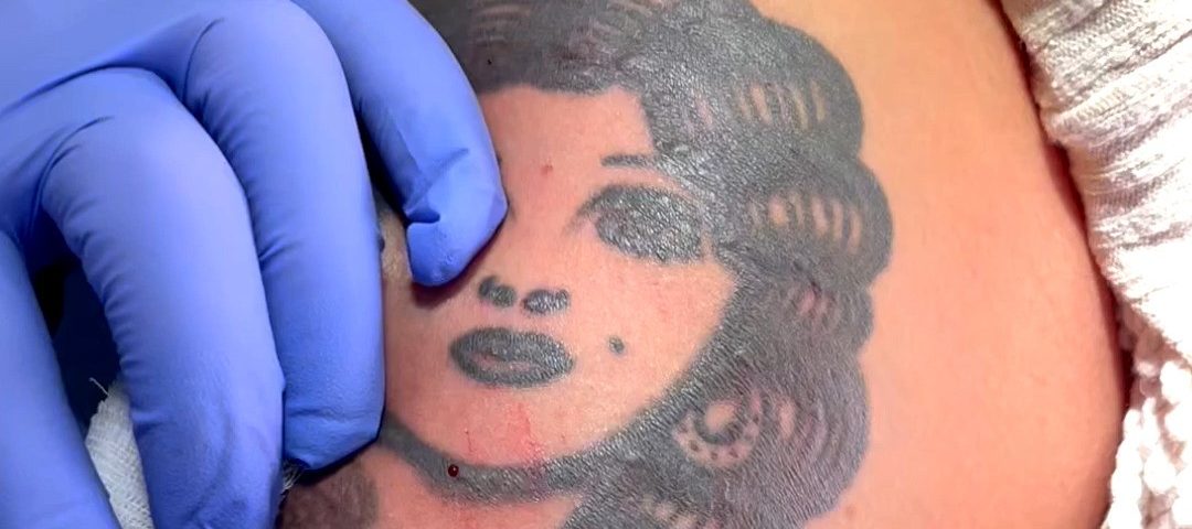 rimozione_laser_tatuaggio_catania