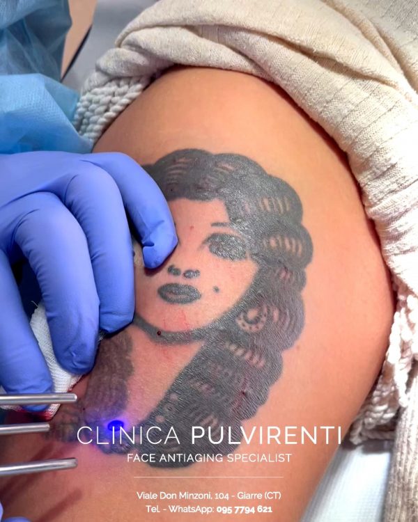 rimozione_laser_tatuaggio_catania